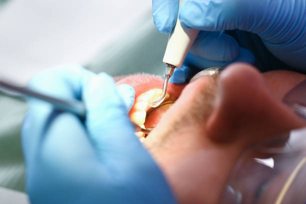 Best Emergency Tooth Extraction in Ocean View, DE